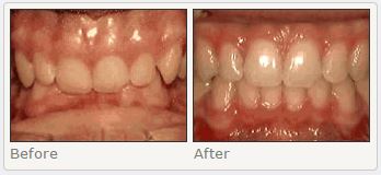 Deep overbite