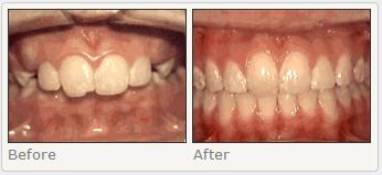 Overjet: Front teeth that are protruding