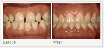 Spacing of teeth