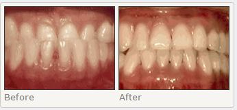 Underbite: Lower teeth extend out in front of the upper teeth